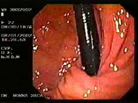 Post Fundoplication Endoscopic Examination (3 of 5)