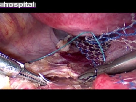 Treatment For Uterine Prolapse - Sacrocervicopexy