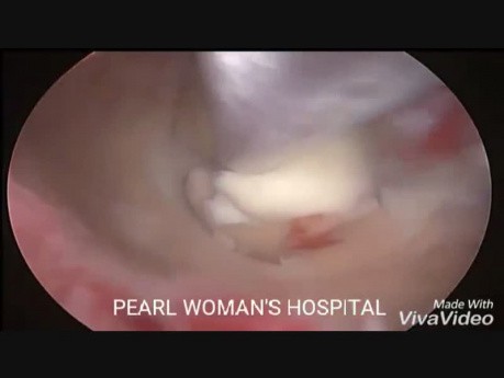 SM Fibroid Removal Hystroscopic Morcellator