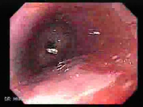 Barrett's Esophagus of long segment (6 of 24)