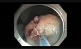 B Piecemeal Resection