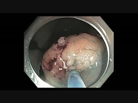 B Piecemeal Resection