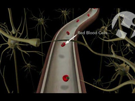 Atherosclerosis