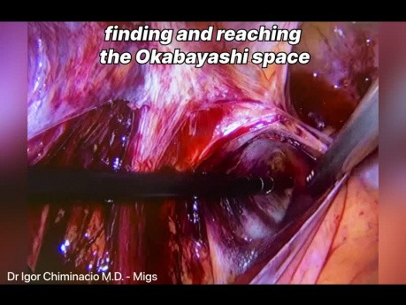 Okabayashi Space Dissection for Endometriosis 