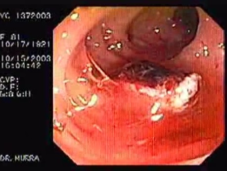Tubulo - Villous Adenoma - Endoscopy (17 of 28)