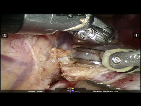 Extralobar Pulmonary Sequestration