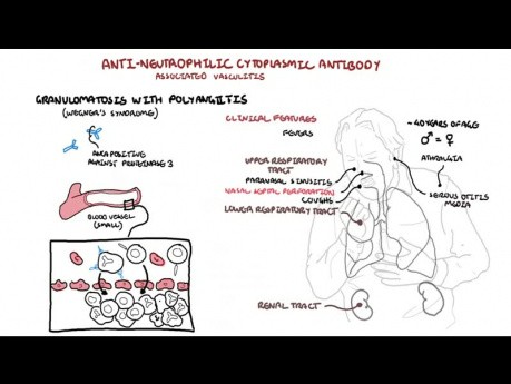 Wegeners Syndrome - Granulomatosis with Polyangiitis (Pathophysiology, Symptoms, Treatment)