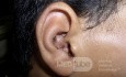 Ramsay Hunt Syndrome