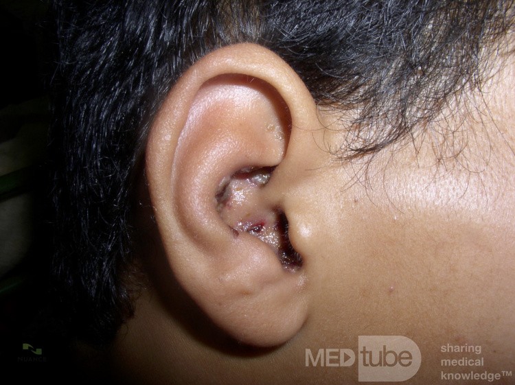Ramsay Hunt Syndrome