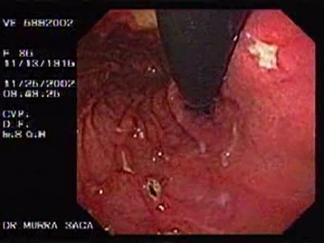 Multiple Gastric Ulcers - Eleven Ulcers Visible in Retroflexed View