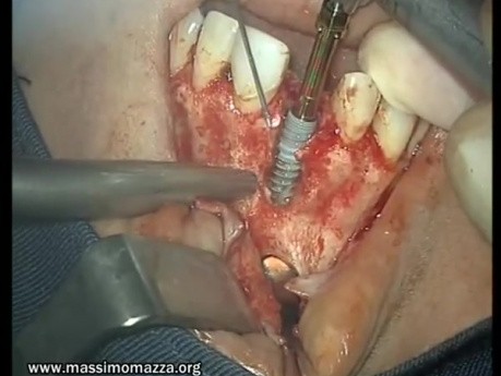Reconstruction Of Bone - Intra-Bone Implant
