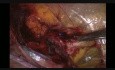 Laparoscopic Hernia Repair TAPP for Strangulated Direct İnguinal Hernia in Female Patient
