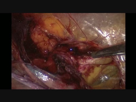 Laparoscopic Hernia Repair TAPP for Strangulated Direct İnguinal Hernia in Female Patient