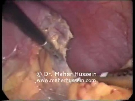 Left Adrenalectomy - Laparoscopic Approach