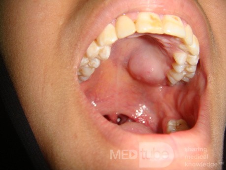 Lipoma in heard palate 