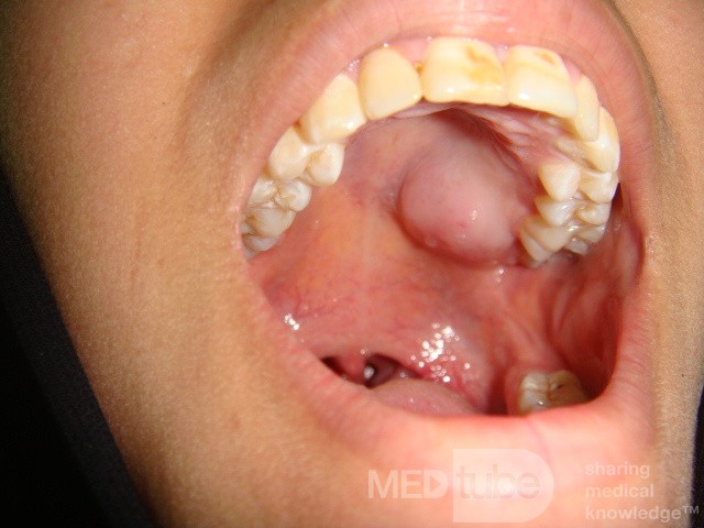Lipoma in heard palate 