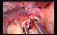 Difficult Thoracoscopic Bronchial Anastomosis (Right Upper Sleeve Lobectomy)