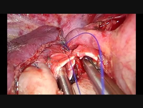 Difficult Thoracoscopic Bronchial Anastomosis (Right Upper Sleeve Lobectomy)