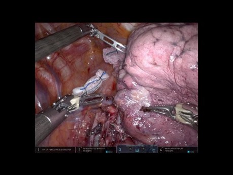 Robotic Right Upper Lobe S2 Segmentectomy