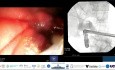 ERCP in Locally Advanced Pancreatic Cancer, what Happens when your ERCP Landmarks Disappear?