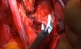 Radical Hysterectomy Resection of Cardinal Ligament (Lateral Parametria)