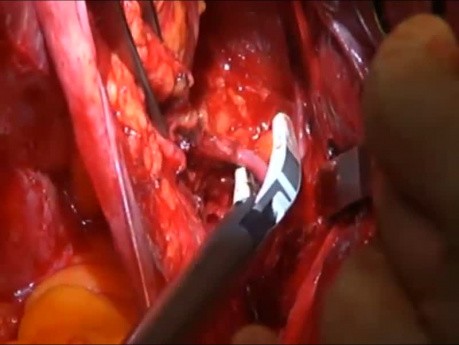 Radical Hysterectomy Resection of Cardinal Ligament (Lateral Parametria)