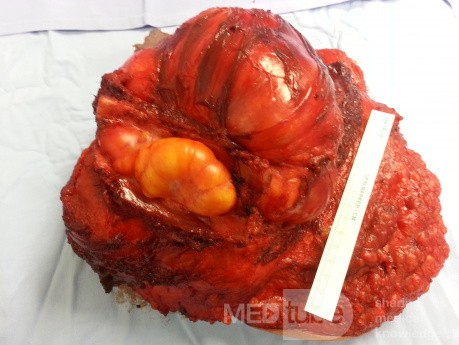 Liposarcoma of the Left Breast Invading the Underlying Intercostal Space - Posterior Margin