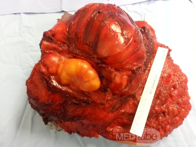 Liposarcoma of the Left Breast Invading the Underlying Intercostal Space - Posterior Margin