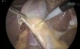Laparoscopic Cholecystectomy - a Branch of Portal Vein in the Gallbladder Bed