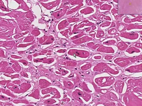 Amyloidosis - Heart - Histopathology