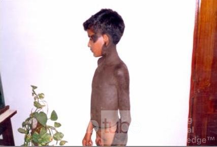 Hyperpigmentation Of The Skin - Other Shot (2)
