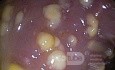 Endoscopic appearance of the Pseudomembranous colitis