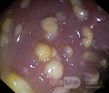 Endoscopic appearance of the Pseudomembranous colitis