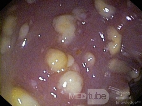Endoscopic appearance of the Pseudomembranous colitis