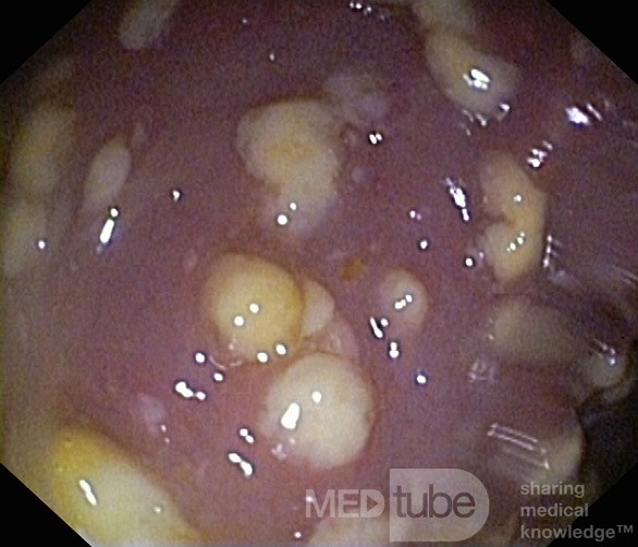 Endoscopic appearance of the Pseudomembranous colitis
