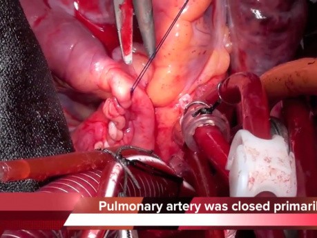 Amplatzer Device Embolization Of The Pulmonary Artery