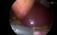 Laparoscopic Sleeve Gastrectomy