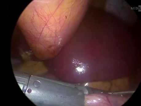 Laparoscopic Sleeve Gastrectomy