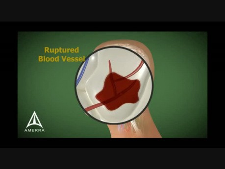 Stroke - 3D Medical Animation