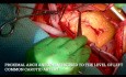 Ascending Aortic Aneurysm Involving the Proximal Arch of Aorta