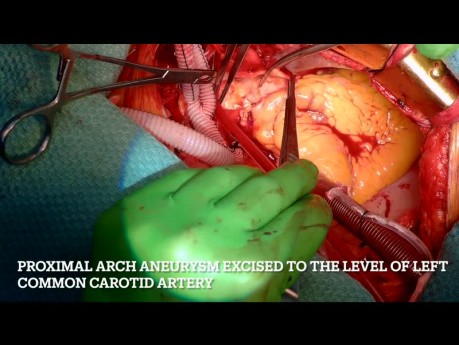 Ascending Aortic Aneurysm Involving the Proximal Arch of Aorta