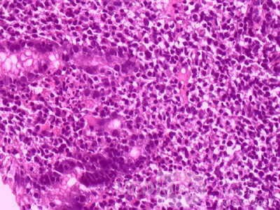 Gastric Lymphoma (8 of 10)