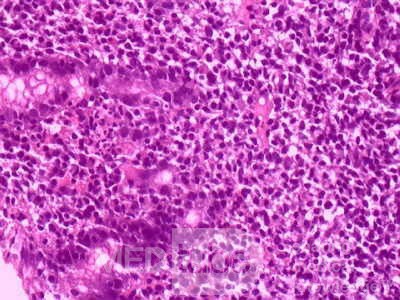 Gastric Lymphoma (8 of 10)