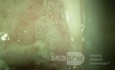 Colposcopy - Mosaic Pattern (CIN3)