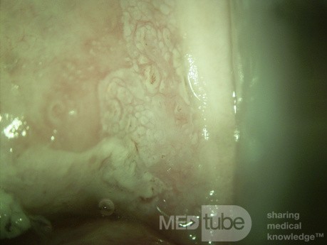 Colposcopy - Mosaic Pattern (CIN3)