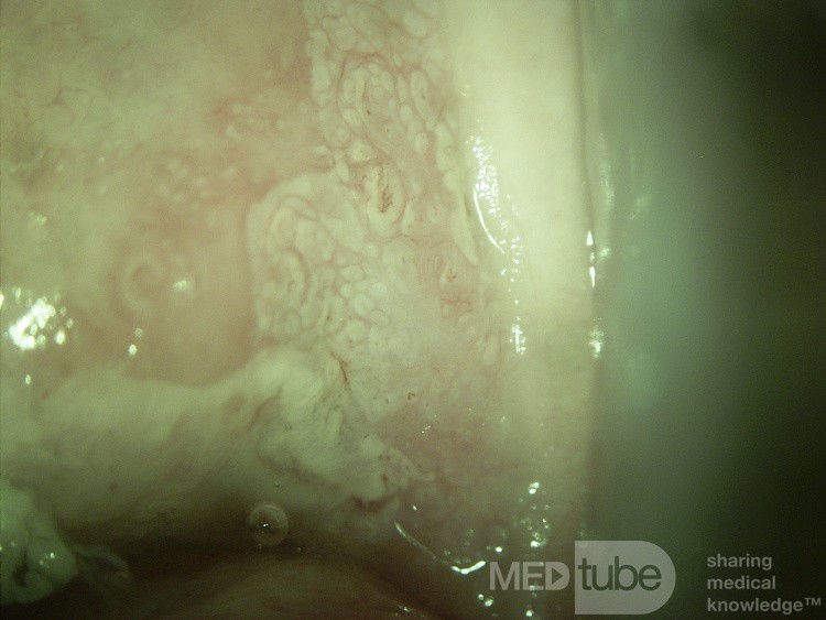 Colposcopy - Mosaic Pattern (CIN3)