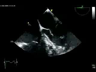 Severe Aortic Valve Regurgitation