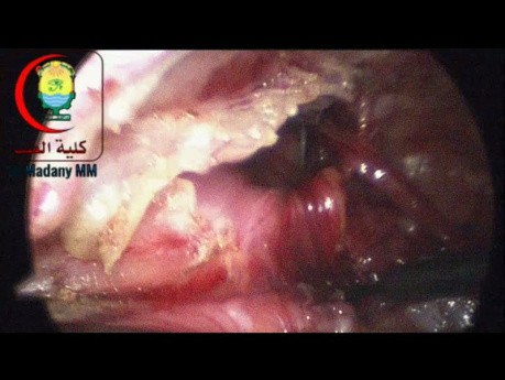 3mm Laparoscopic Instruments Are Fragile But May Be Preferred For Use In Infants