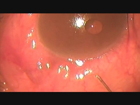 Failed Recently Done Microtrack Filtration due to Cyst Formation. Re-operation.