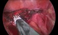 V-Lock Endostich